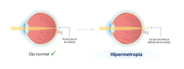 Lentes correctivos para hipermetropía