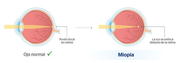 Comparación entre ojo normal y ojo con miopía