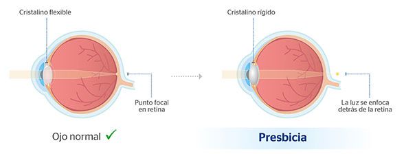Comparación entre ojo normal y ojo con presbicia