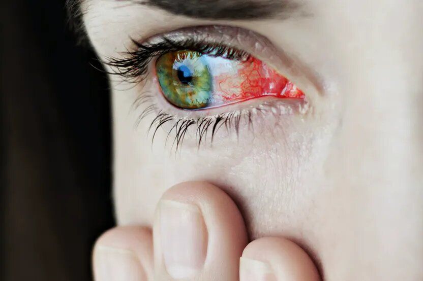 Problemas con Lentes de Contacto